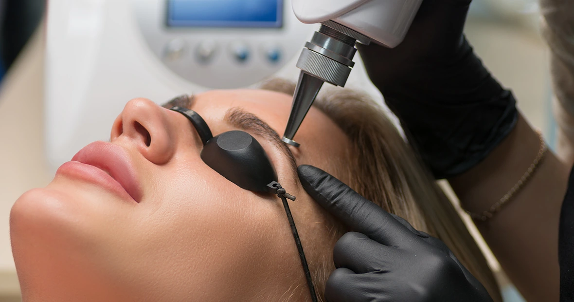 sourcils au laser